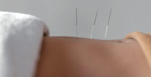 L'acupuncture en medecine traditionelle chinoise chez Naturelle bio toulouse